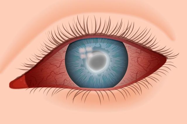 Боль в глазах при движении глазного яблока – причины и лечение