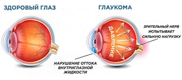 Глаукома – причины, симптомы, лечение и профилактика (фото)