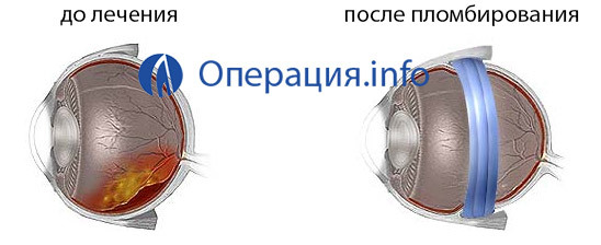 Виды операций при отслоении сетчатки глаза и послеоперационный период