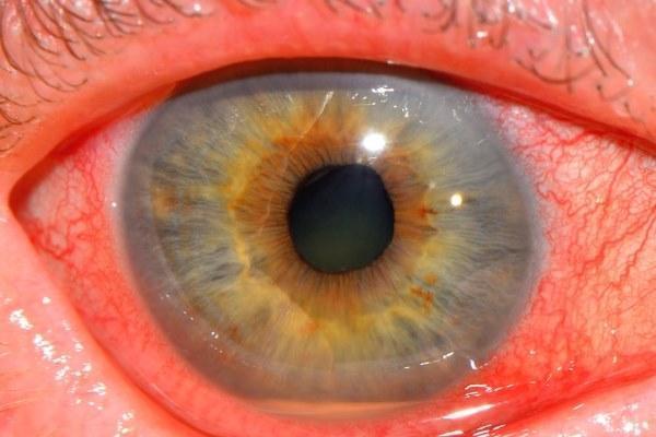 Иридоциклит глаза — причины, симптомы и лечение (фото)
