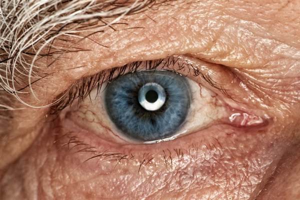 Возрастная катаракта (старческая) — причины, симптомы и лечения (фото)