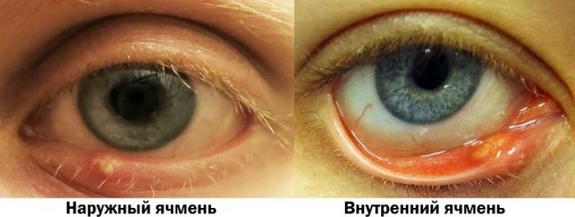 Внутренний ячмень на глазу – причины, симптомы и лечение (фото)
