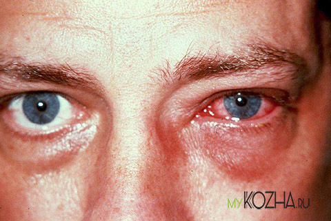 Ожог сетчатки глаза – симптомы и способы лечения