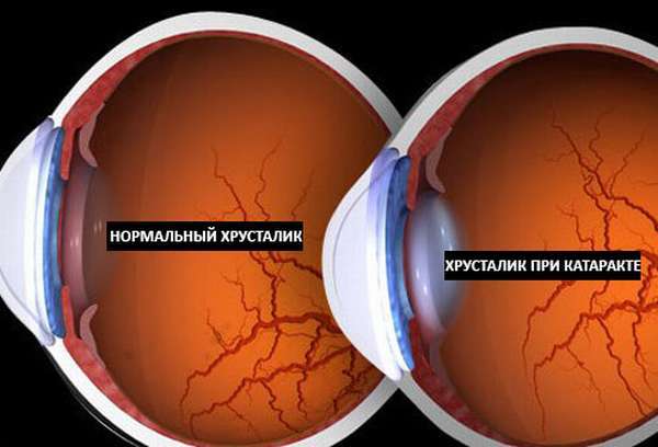 Начальная стадия катаракты — симптомы и лечение. Что делать при появлении начальной катаракты