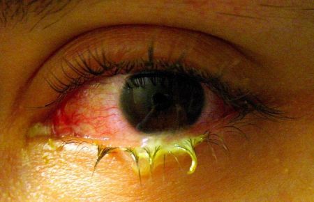 Гонококковый конъюнктивит — симптомы и лечение (гонорея глаз)