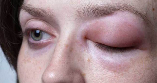 Аллергический отек глаз и век — причины и лечение. Как снять отек быстро