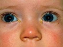 Блефарит у детей — причины, симптомы и лечение (фото)