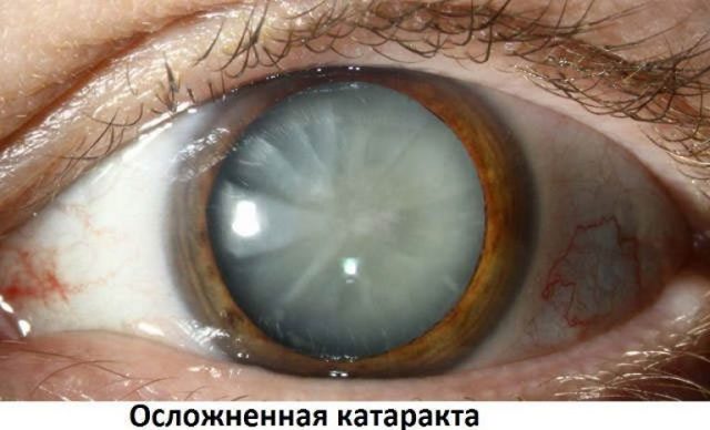 Осложненная катаракта глаз — причины, симптомы и лечение. Стадии заболевания