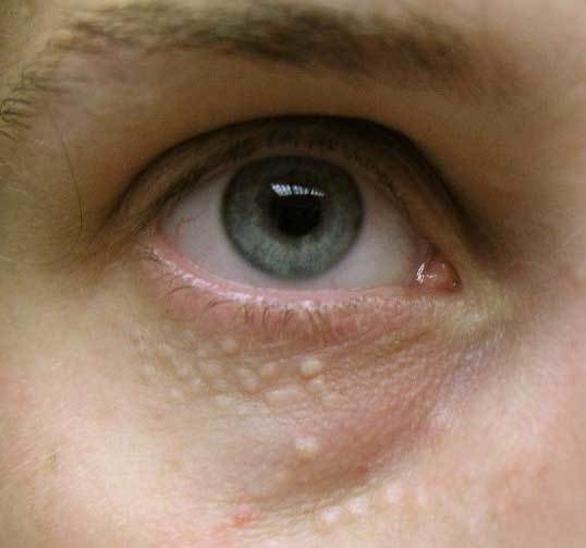 Белые точки под глазами – причины и лечение