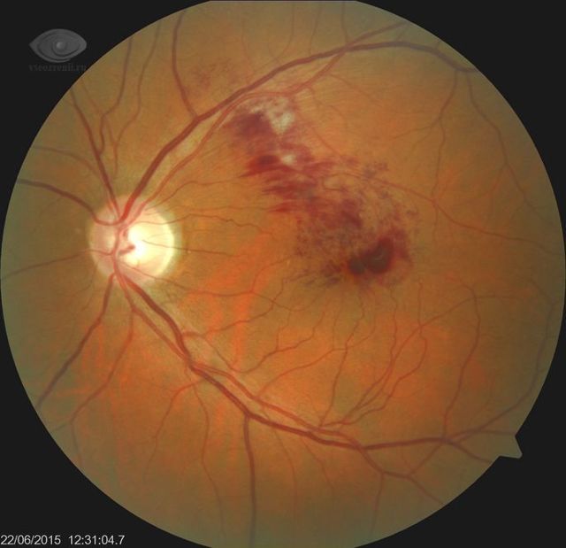 Макулярный отек сетчатки глаза – причины и лечение
