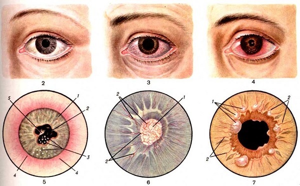 Иридоциклит глаза — причины, симптомы и лечение (фото)