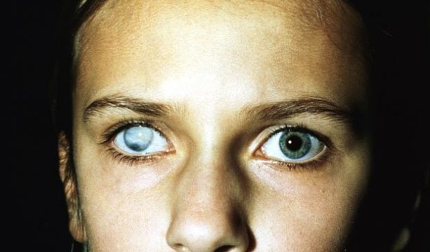 Как можно лечить помутнение роговицы глаза?