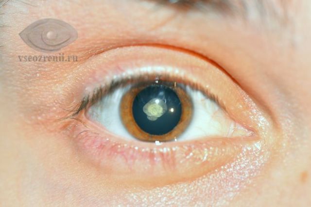 Врожденная катаракта у детей и взрослых – лечение, причины и симптомы, виды врожденной катаракты глаза