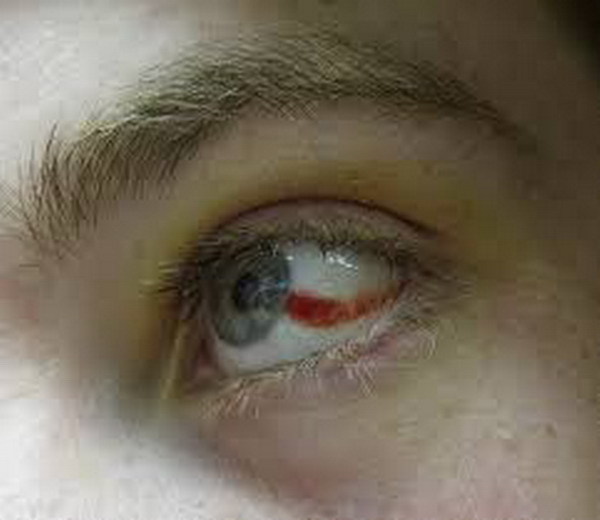 Кровоизлияние в глаз – причины и лечение, что делать при кровоизлиянии