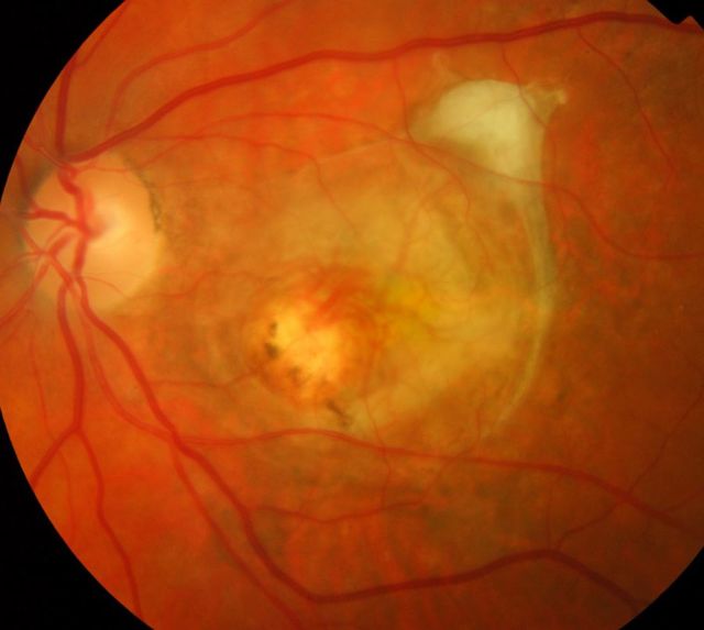 Атрофия сетчатки глаза — причины, симптомы и лечение у человека - Офтальмо