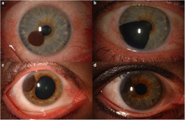 Меланома хориоидеи глаза — причины, симптомы и лечение