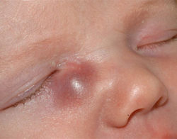 Гноится глаза у новорожденного (грудничка): что делать и чем лечить