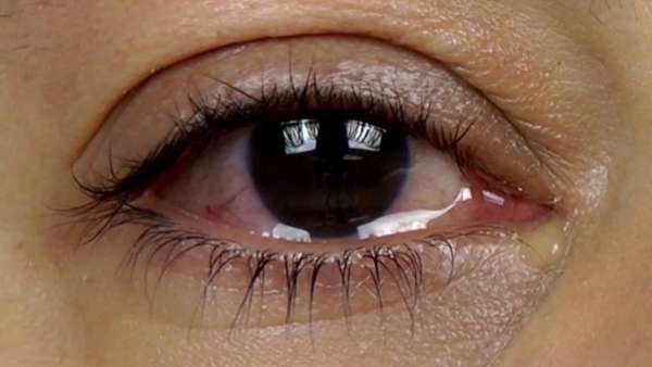 Ожог глаз кварцевой лампой – симптомы, лечение и первая помощь