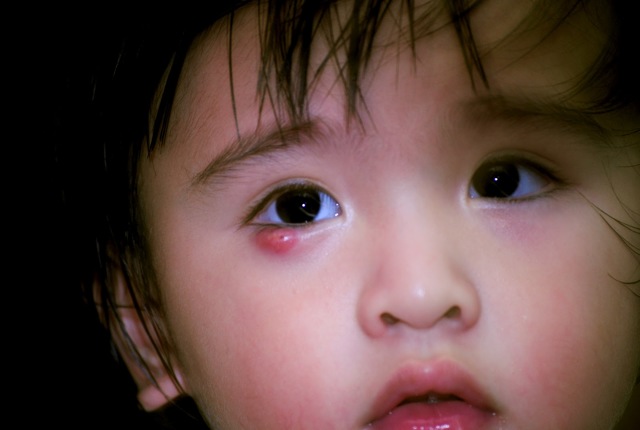 Лечение халязиона у ребенка – причины, симптомы и способы удаления у детей