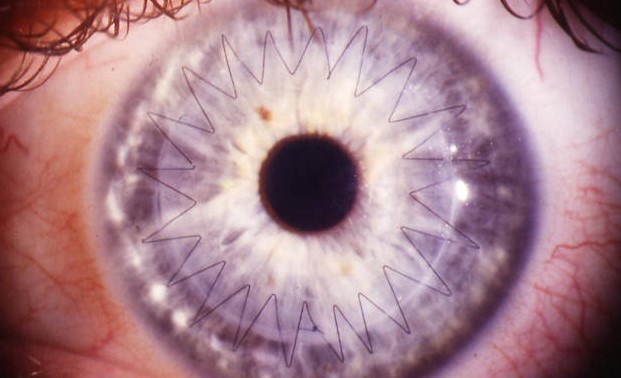 Операция при астигматизме на глаза — виды и стоимость (видео)