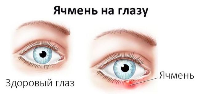 Заразен ли ячмень на глазу, передается окружающим или нет