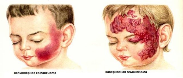 Гемангиома на веке у детей — причины, симптомы и лечение