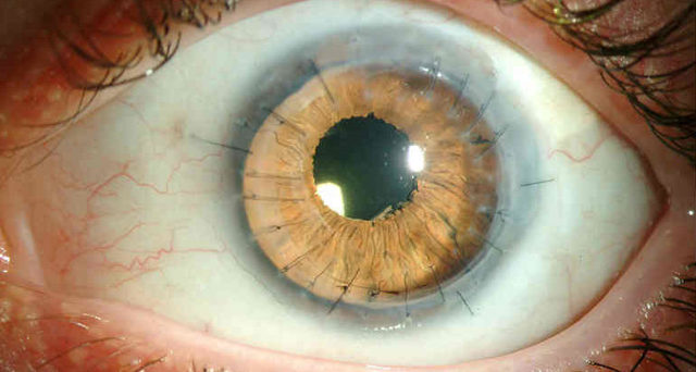 Дистрофия роговицы глаза: причины, симптомы и лечение