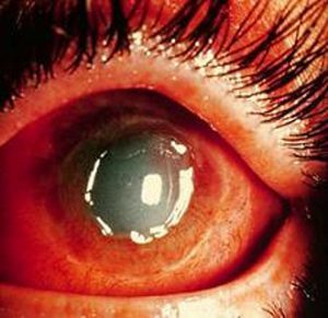 Ожог роговицы глаза – симптомы и лечение (фото). Химический ожог.