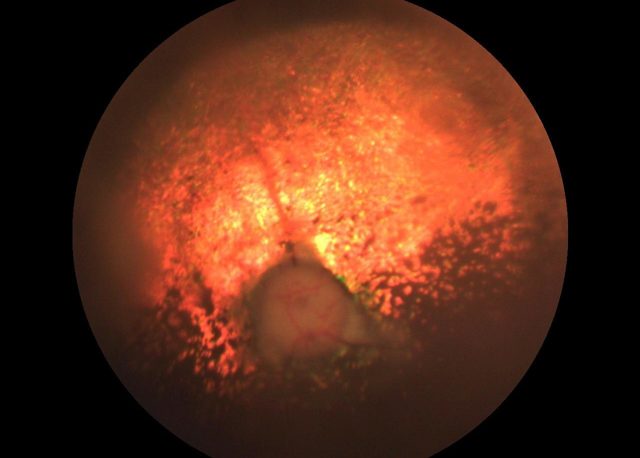 Атрофия сетчатки глаза — причины, симптомы и лечение у человека
