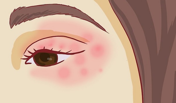 Покраснение вокруг глаз – причины и лечение