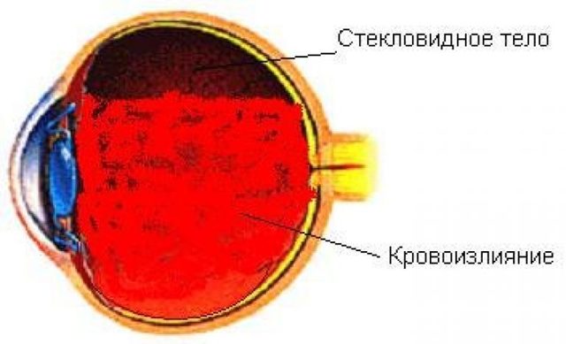 Кровоизлияние в стекловидное тело глаза – причины, симптомы и лечение