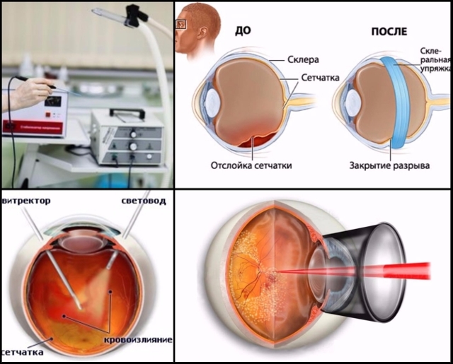 Отслоение сетчатки глаза – причины, симптомы и лечение (фото)