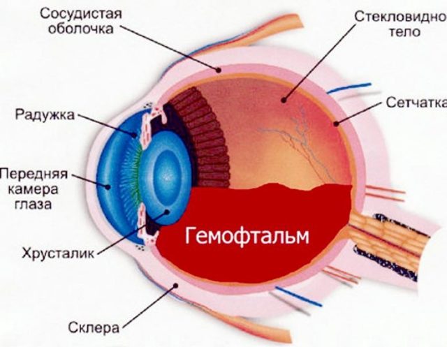 Гемофтальм глаза – причины, симптомы и лечение (фото). Гемофтальм частичный и тотальный.