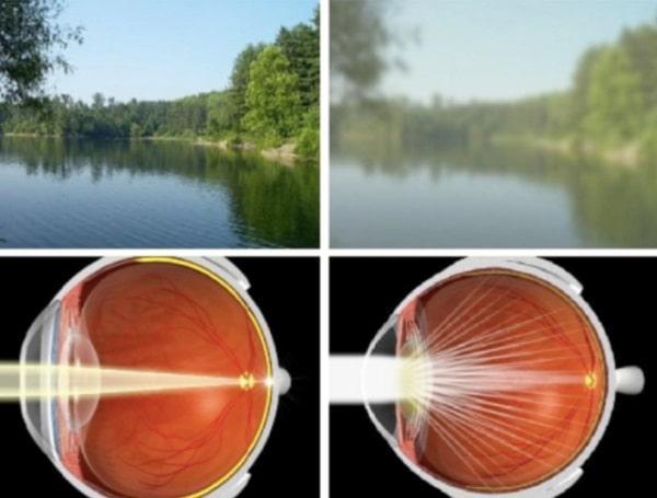 Возможные осложнения после замены хрусталика глаза при катаракте