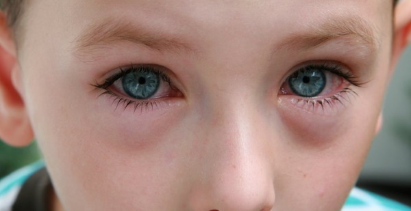 Капли для глаз от аллергии взрослым и детям – названия и описание
