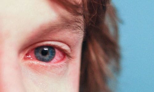Аллергический конъюнктивит глаз – симптомы и лечение