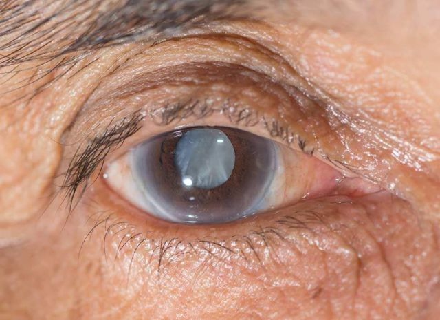 Диабетическая катаракта — симптомы и лечение (операция, фото). Профилактика катаракты при диабете