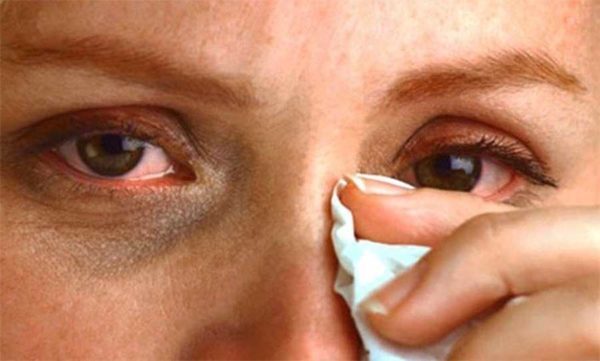 Аллергия на веках глаз – причины, симптомы и лечение, мази от аллергии