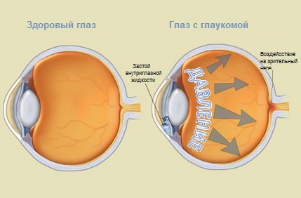 Группа инвалидности при глаукоме — дают ли группу при глаукоме
