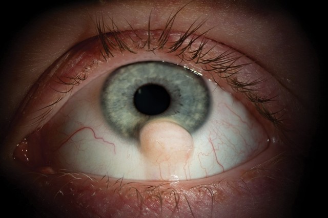 Киста глаза — причины, симптомы и лечение (фото)
