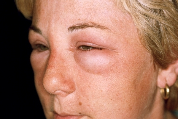 Аллергия на глазах – причины, симптомы, виды и как лечить (фото)