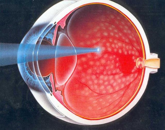Диабетическая ретинопатия – причины, симптомы и лечение