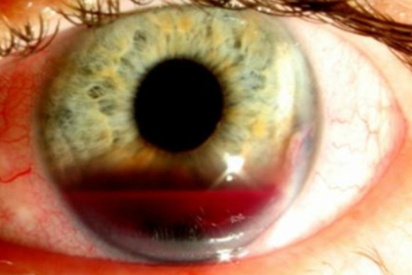 Гифема глаза — причины, симптомы и лечение болезни