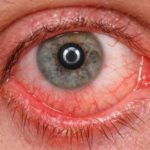 Отслойка стекловидного тела глаза – причины, симптомы и лечение