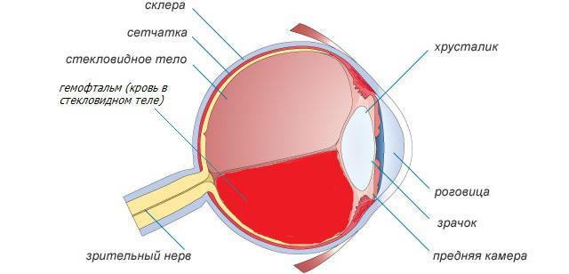 Кровоизлияние в стекловидное тело глаза – причины, симптомы и лечение