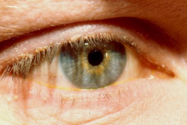 Блефароконъюнктивит глаз – причины, симптомы и лечение (фото)