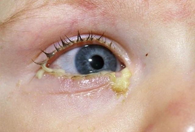 Конъюнктивит глаз у детей – признаки, симптомы и лечения у ребенка