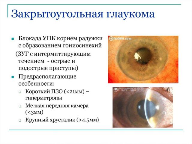 Вторичная глаукома – классификация, причины и лечение (фото)