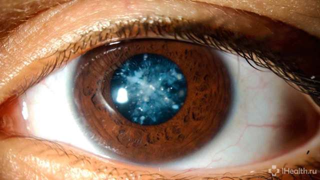 Катаракта глаза. Причины, симптомы и лечение катаракты