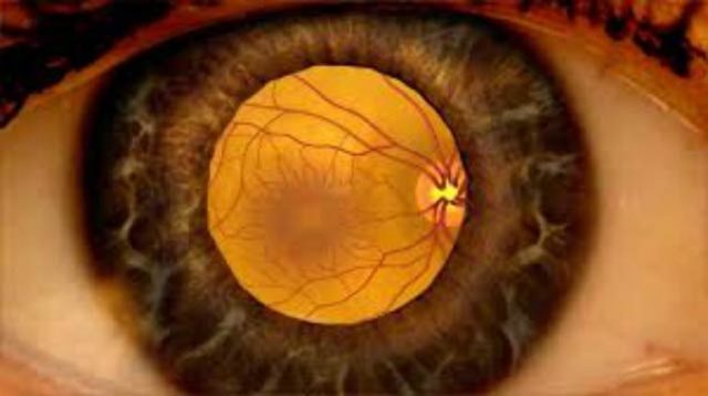 Отек сетчатки глаза – причины и лечение